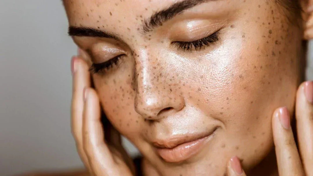 Microneedling with Hyaluronic Acid