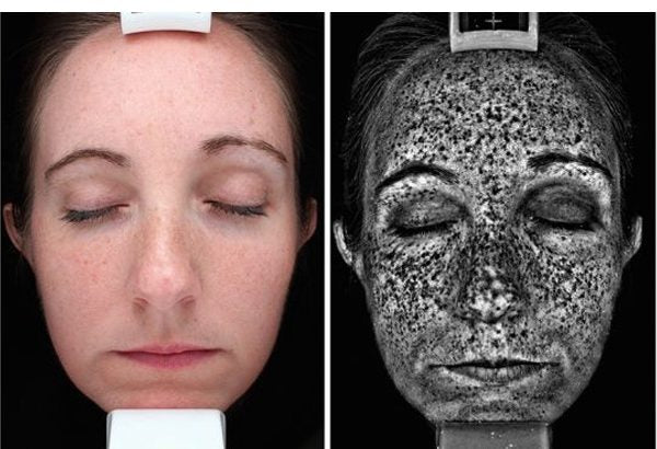 Image of sun damage built up face