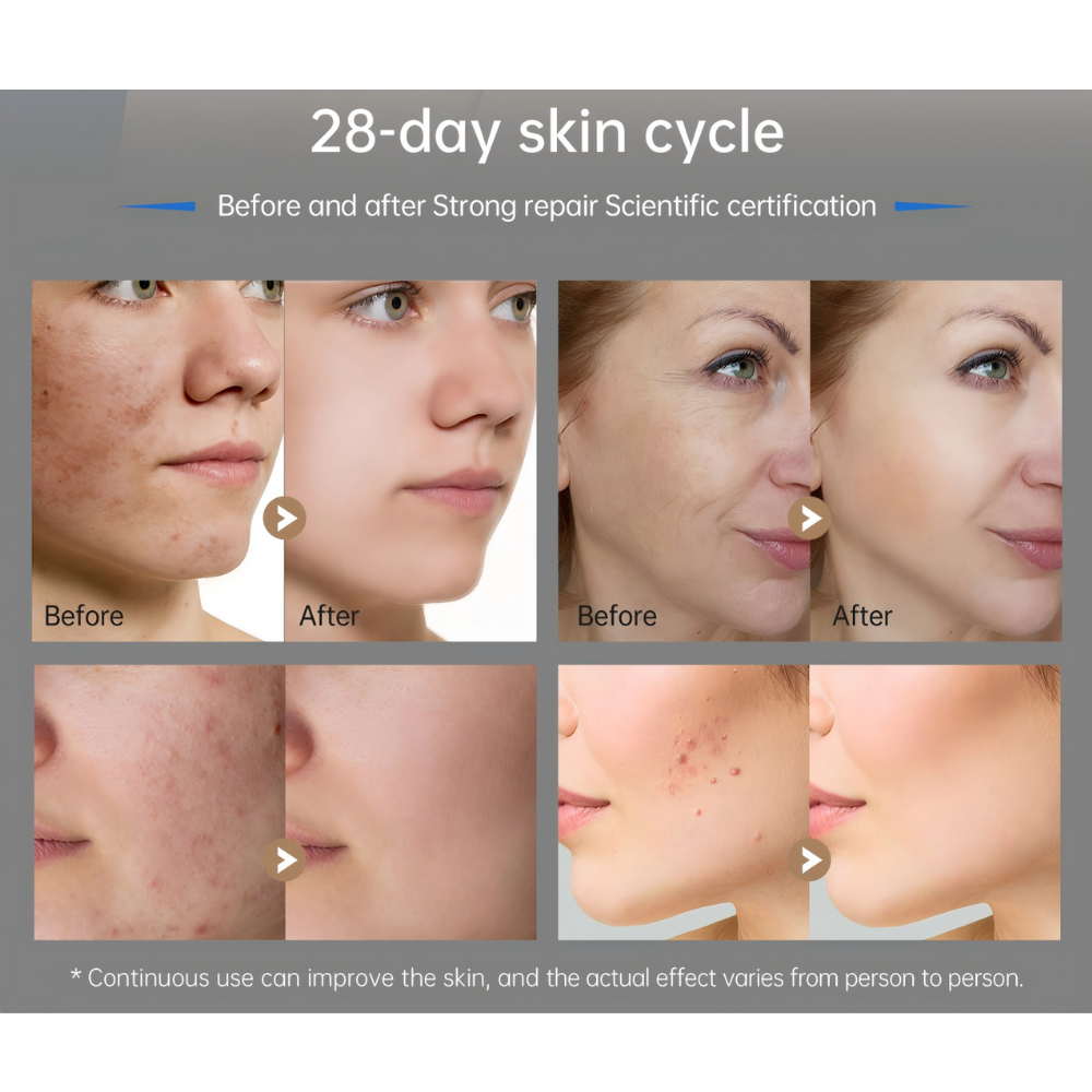 Before and after skin improvement results with a 28-day cycle after using Dr. Pen M9 Microneedling Pen. Skin looks smoother, cleaner, pores minimised.